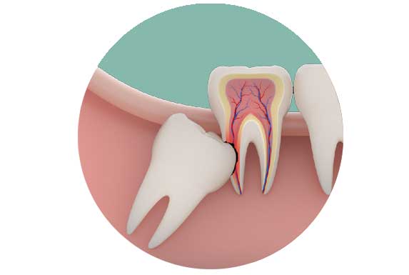 Teeth Extraction Karina Mattaliano and associates dental clinic