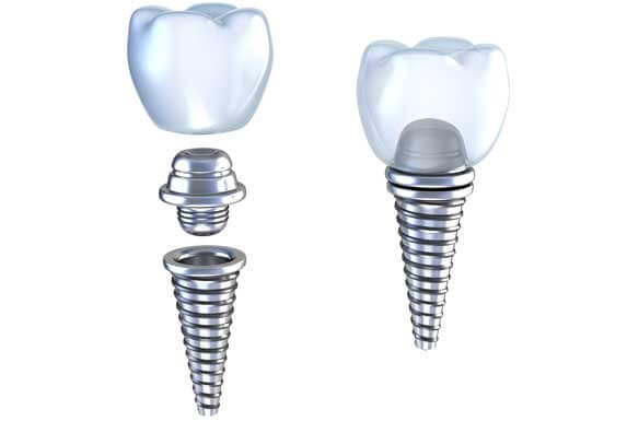 Implantologie par Clinique dentaire Karina Mattaliano