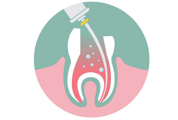 Root canal and endodontic treatment at Karina Mattaliano and associates  dental clinic