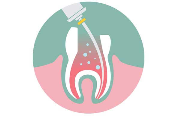 Traitement de canal par la Clinique dentaire Karina Mattaliano